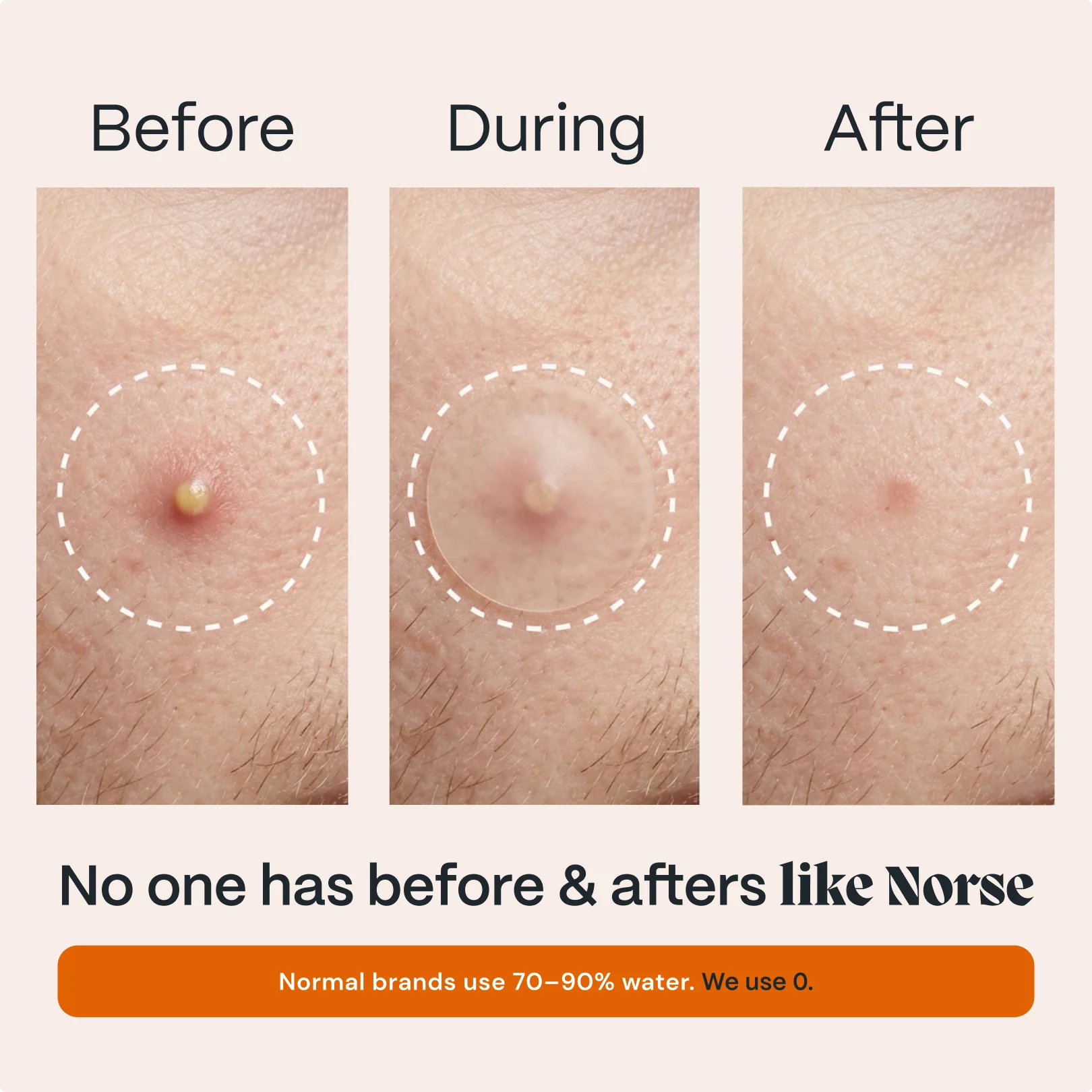 Acne Patches with Arctic Herbs - Image 4