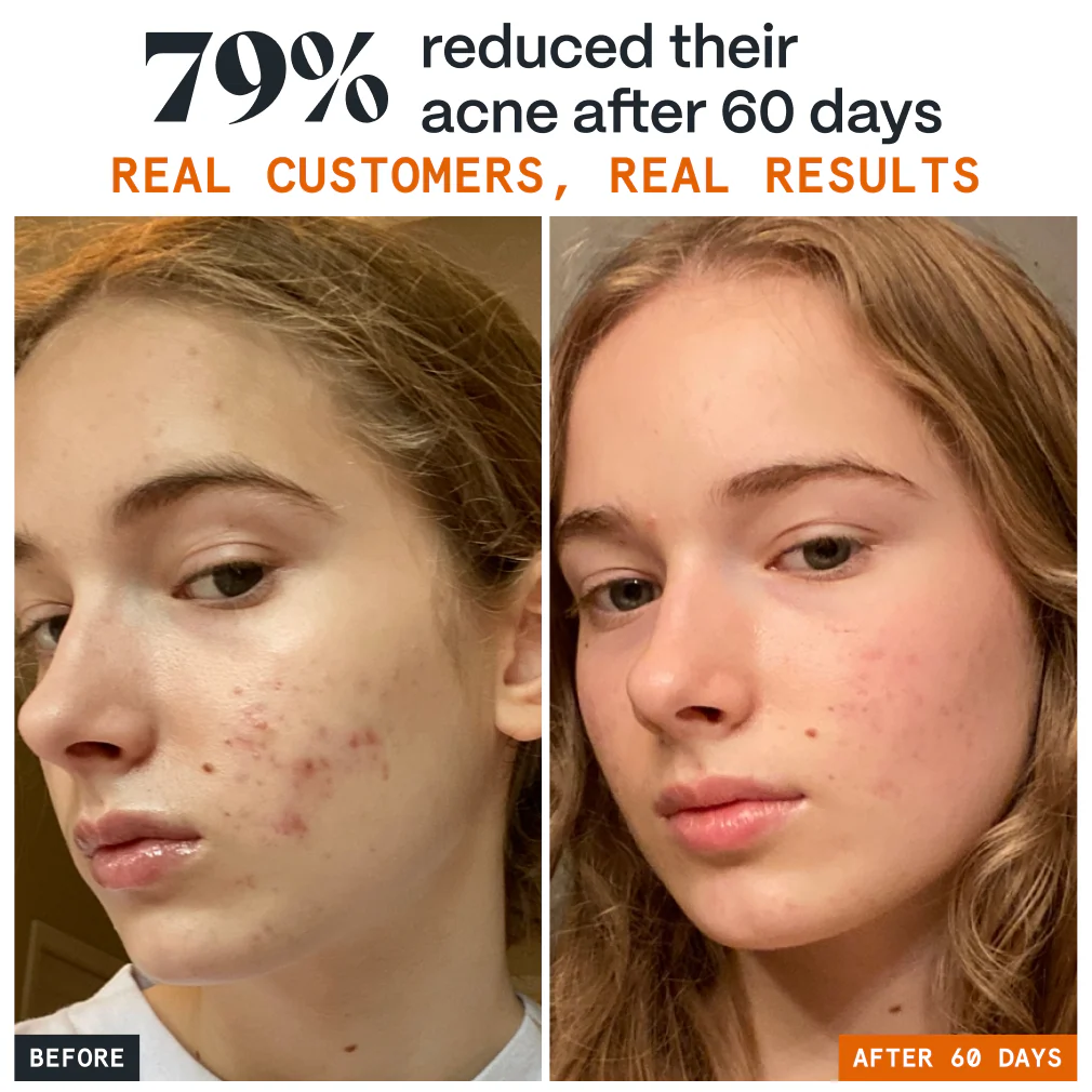 Pimple Stopper Night Balm - Image 11