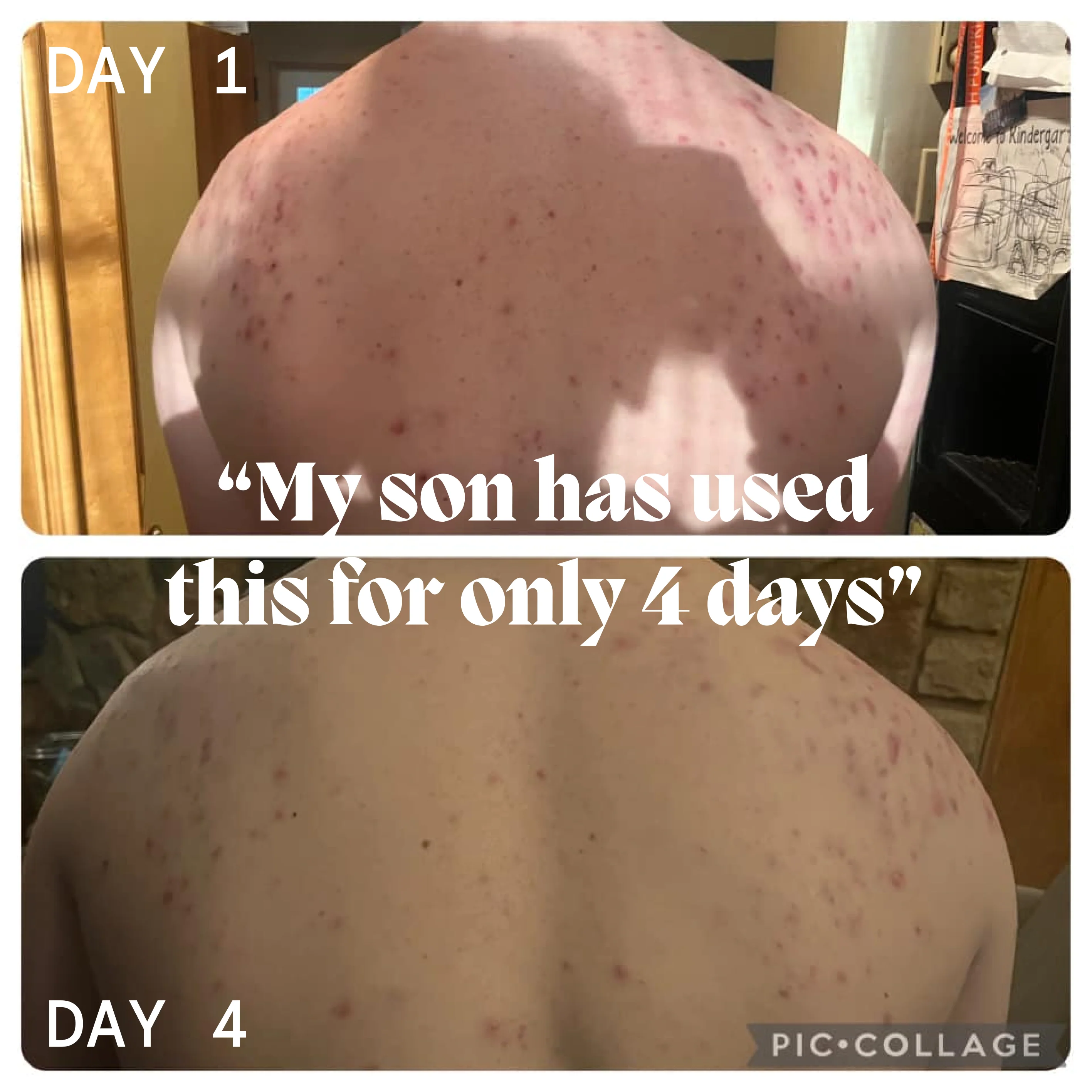 Body Balm for Acne Prone Skin - Image 7