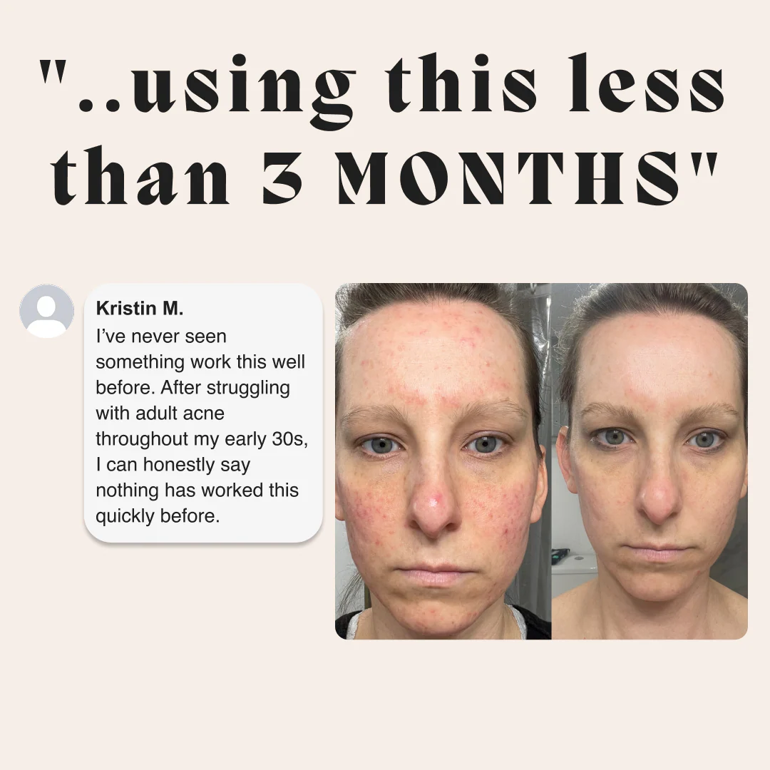 Complete Gut Repair & Hormonal Balance System for Female Acne - Image 9