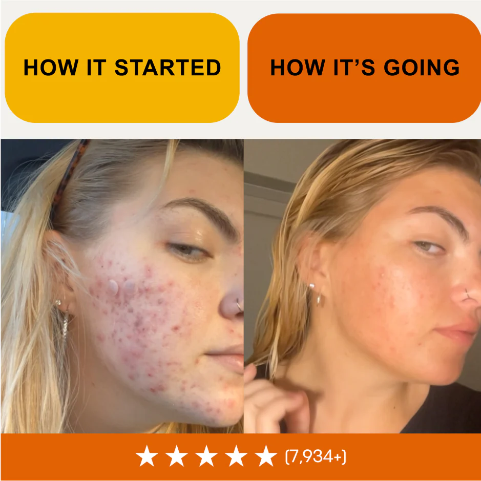 The Complete Acne Stopper Starter Pack - Image 12